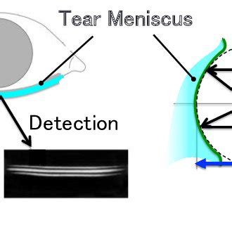 Tear Volume Measurement 